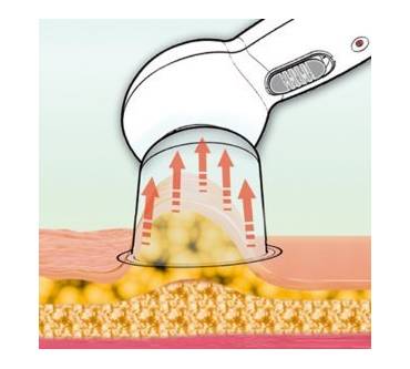 Produktbild Prorelax Vakuum Massagegerät